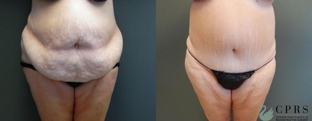Mini Tummy Tuck result at Center for Plastic & Reconstructive Surgery (Kendall Peters, MD) in Orlando, FL