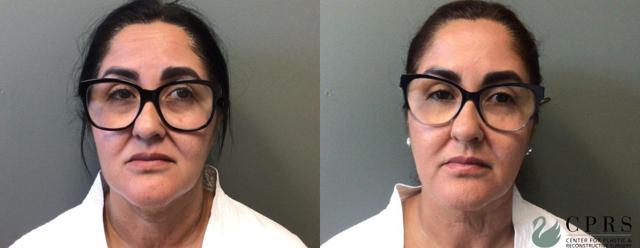 Neck Lift result at Center for Plastic & Reconstructive Surgery (Kendall Peters, MD) in Orlando, FL