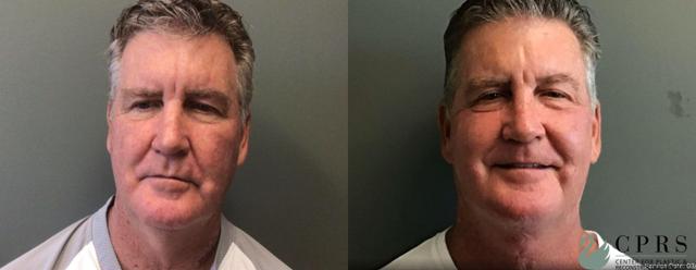 Neck Lift result at Center for Plastic & Reconstructive Surgery (Kendall Peters, MD) in Orlando, FL