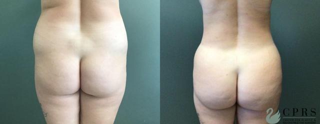 Brazilian Butt Lift result at Center for Plastic & Reconstructive Surgery (Kendall Peters, MD) in Orlando, FL