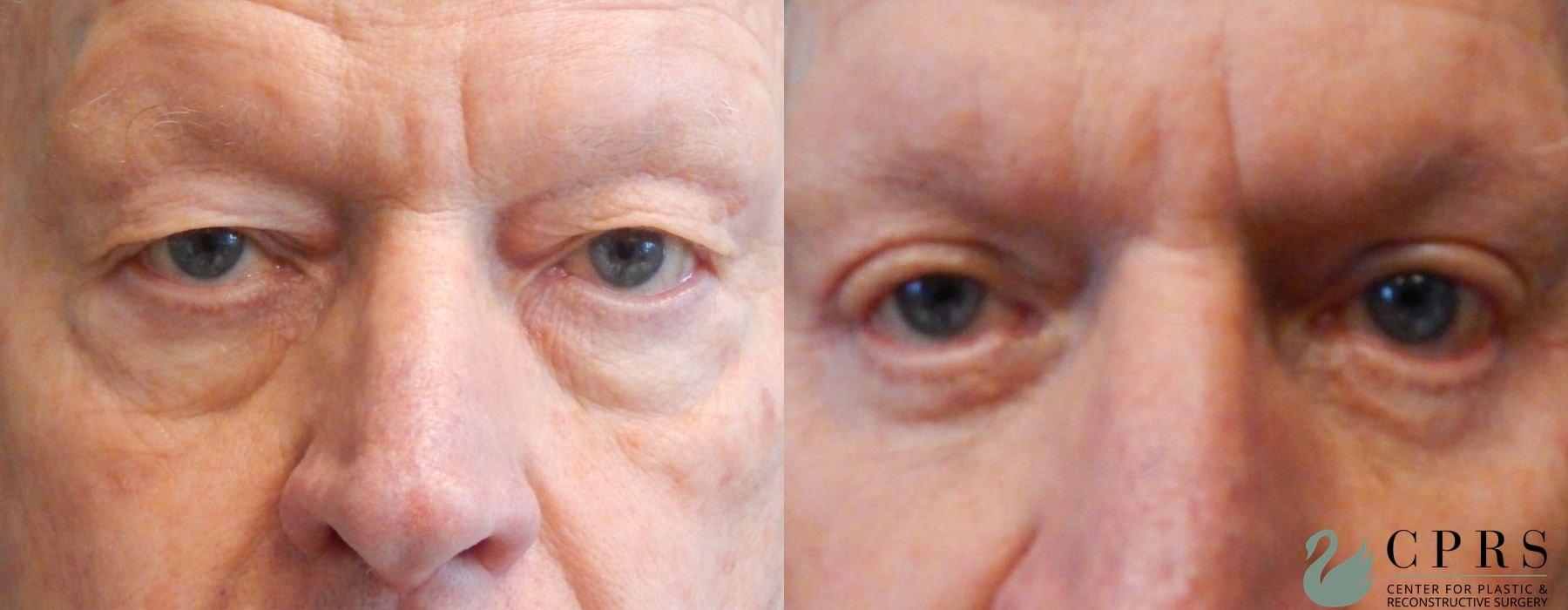 Center for Plastic & Reconstructive Surgery (Kendall Peters, MD) eyelid lift result — Orlando, FL