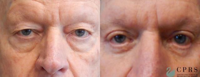 Blepharoplasty result at Center for Plastic & Reconstructive Surgery (Kendall Peters, MD) in Orlando, FL