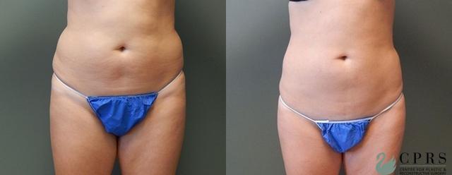 Liposuction result at Center for Plastic & Reconstructive Surgery (Kendall Peters, MD) in Orlando, FL