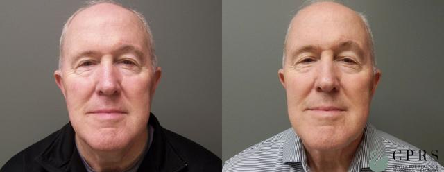 Neck Lift result at Center for Plastic & Reconstructive Surgery (Kendall Peters, MD) in Orlando, FL