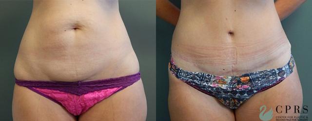 Mommy Makeover result at Center for Plastic & Reconstructive Surgery (Kendall Peters, MD) in Orlando, FL