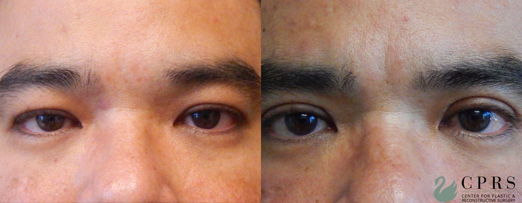 Center for Plastic & Reconstructive Surgery (Kendall Peters, MD) eyelid lift result — Orlando, FL