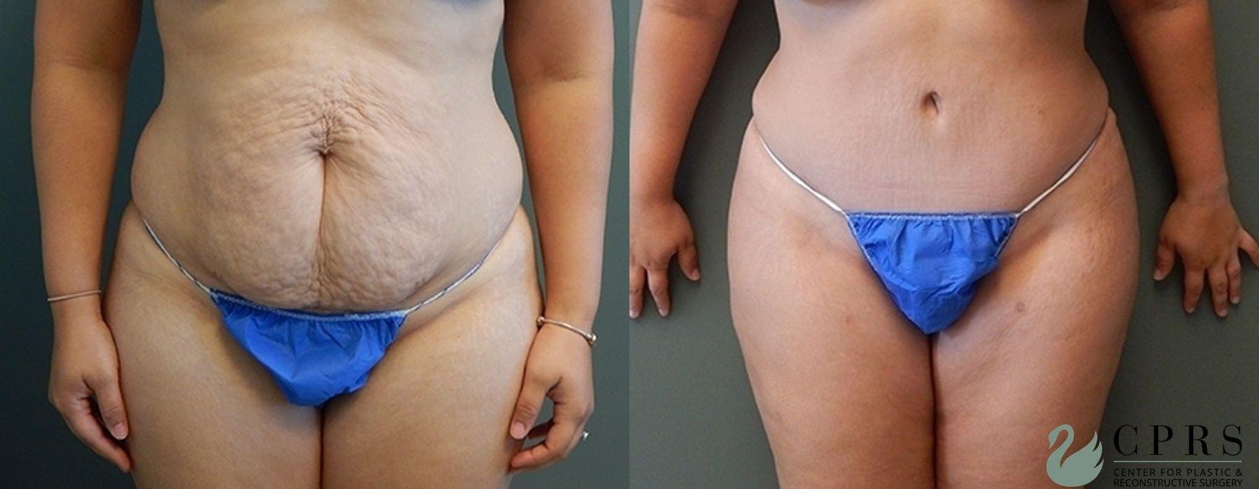 Center for Plastic & Reconstructive Surgery (Kendall Peters, MD) tummy tuck result — Orlando, FL