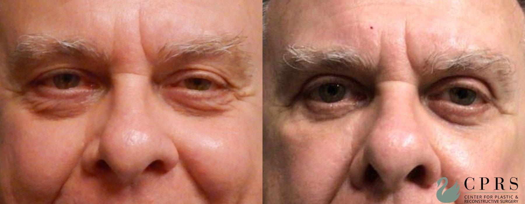 Center for Plastic & Reconstructive Surgery (Kendall Peters, MD) eyelid lift result — Orlando, FL