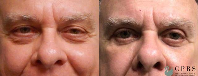 Blepharoplasty result at Center for Plastic & Reconstructive Surgery (Kendall Peters, MD) in Orlando, FL