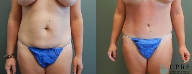 Mommy Makeover result at Center for Plastic & Reconstructive Surgery (Kendall Peters, MD) in Orlando, FL