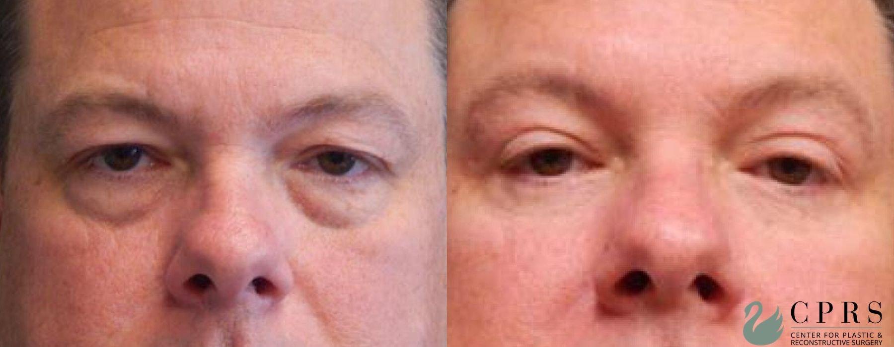 Center for Plastic & Reconstructive Surgery (Kendall Peters, MD) eyelid lift result — Orlando, FL