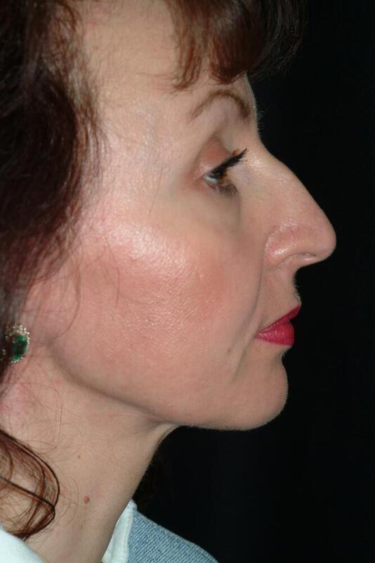 Functional Rhinoplasty before at Hass Plastic Surgery & MedSpa in Palm Beach Gardens, FL