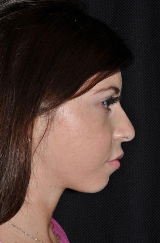 Chin Implant before at Hass Plastic Surgery & MedSpa in Palm Beach Gardens, FL
