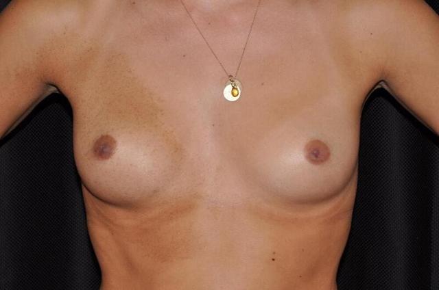 Fat Transfer Breast Augmentation before at Hass Plastic Surgery & MedSpa in Palm Beach Gardens, FL