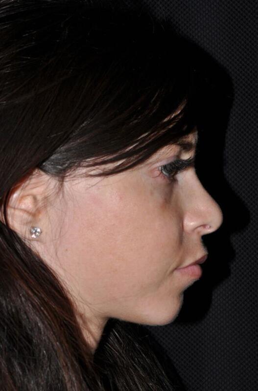 Chin Implant after at Hass Plastic Surgery & MedSpa in Palm Beach Gardens, FL
