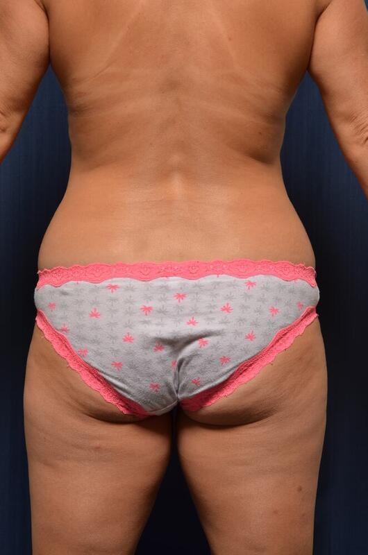 Liposuction before at Hass Plastic Surgery & MedSpa in Palm Beach Gardens, FL