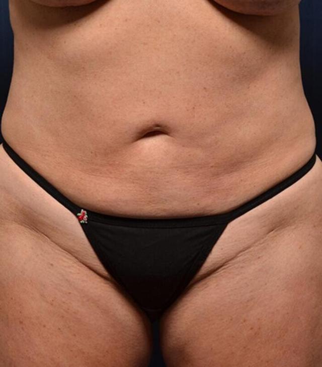 Brazilian Butt Lift before at Hass Plastic Surgery & MedSpa in Palm Beach Gardens, FL