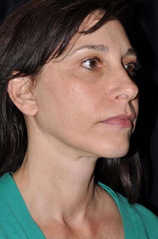 Chin Implant after at Hass Plastic Surgery & MedSpa in Palm Beach Gardens, FL