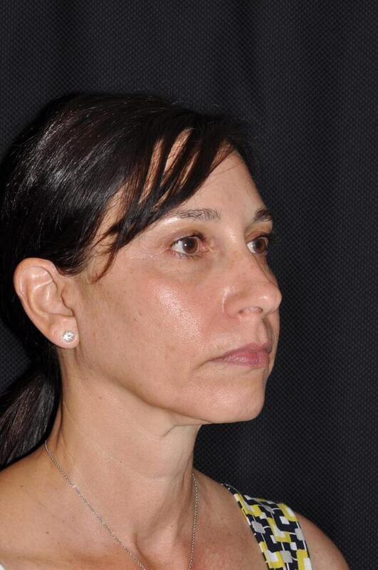 Chin Implant before at Hass Plastic Surgery & MedSpa in Palm Beach Gardens, FL