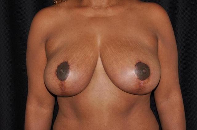 Breast Lift after at Hass Plastic Surgery & MedSpa in Palm Beach Gardens, FL