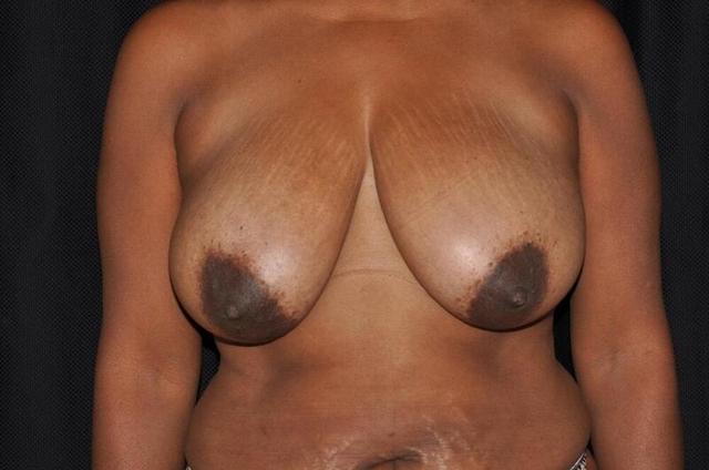 Breast Lift before at Hass Plastic Surgery & MedSpa in Palm Beach Gardens, FL