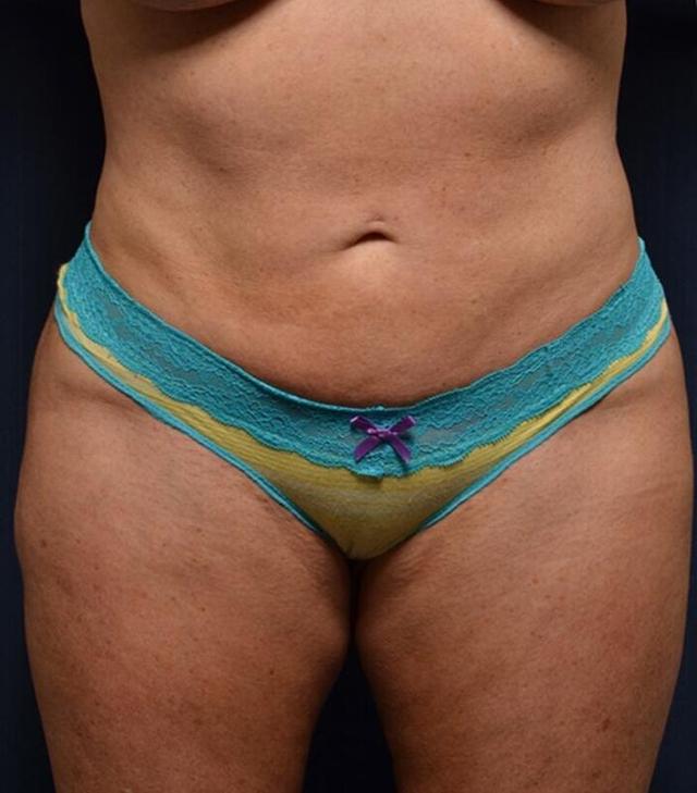 Brazilian Butt Lift after at Hass Plastic Surgery & MedSpa in Palm Beach Gardens, FL