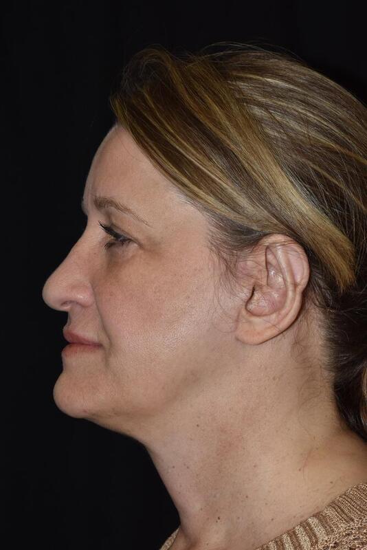 Deep Plane Facelift after at Hass Plastic Surgery & MedSpa in Palm Beach Gardens, FL