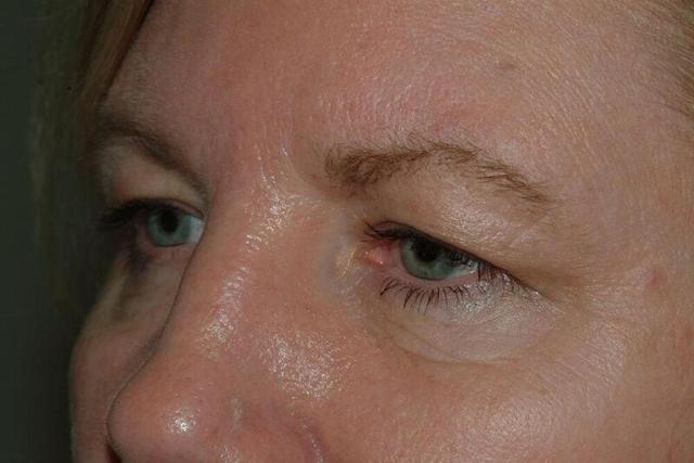 Brow Lift before at Hass Plastic Surgery & MedSpa in Palm Beach Gardens, FL