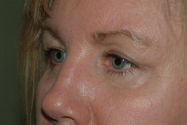 Brow Lift after at Hass Plastic Surgery & MedSpa in Palm Beach Gardens, FL