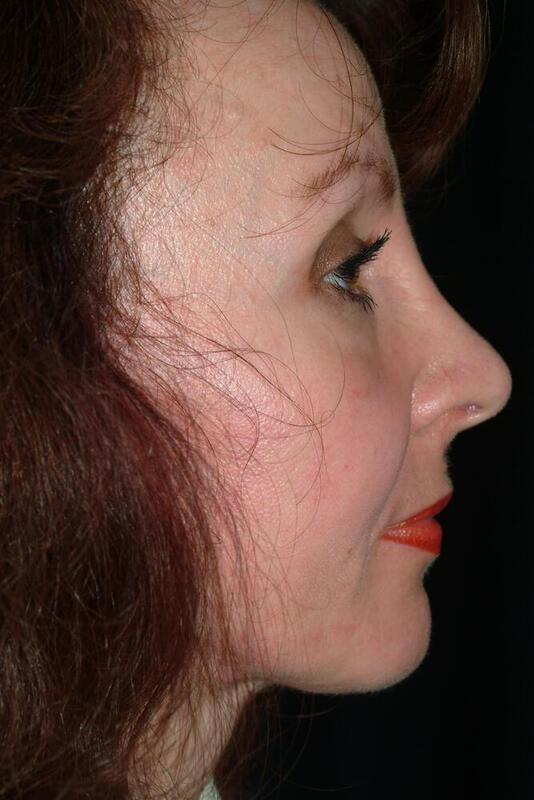 Functional Rhinoplasty after at Hass Plastic Surgery & MedSpa in Palm Beach Gardens, FL