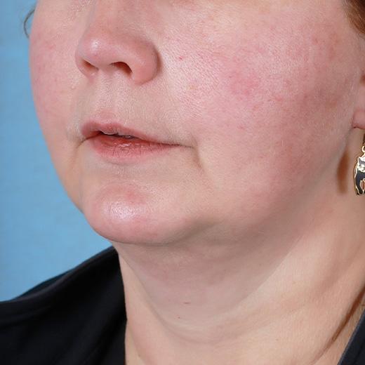 Aesthetic Center at Woodholme facelift after — Baltimore, MD