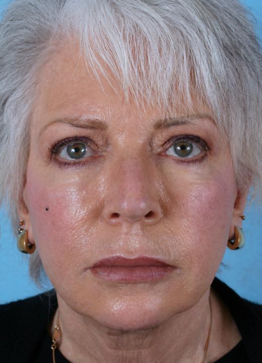 Aesthetic Center at Woodholme facelift after — Baltimore, MD