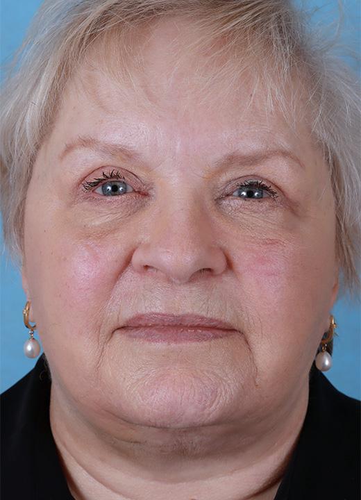 Aesthetic Center at Woodholme facelift after — Baltimore, MD