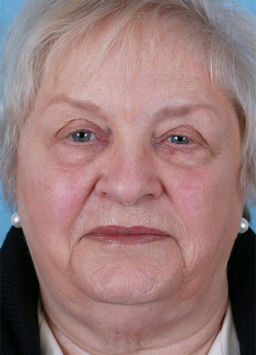 Neck Lift before at Aesthetic Center at Woodholme in Baltimore, MD