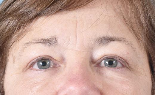 Blepharoplasty after at Aesthetic Center at Woodholme in Baltimore, MD