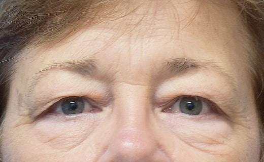 Blepharoplasty before at Aesthetic Center at Woodholme in Baltimore, MD