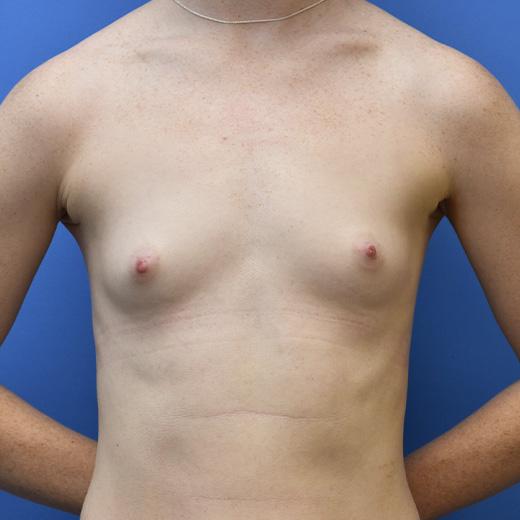 Fat Transfer Breast Augmentation before at Aesthetic Center at Woodholme in Baltimore, MD