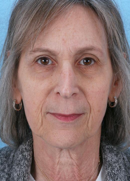 Neck Lift before at Aesthetic Center at Woodholme in Baltimore, MD