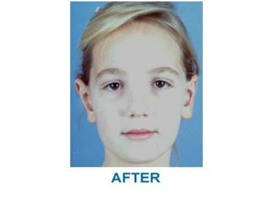 Aesthetic Center at Woodholme otoplasty after — Baltimore, MD