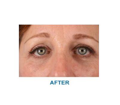 Brow Lift after at Aesthetic Center at Woodholme in Baltimore, MD