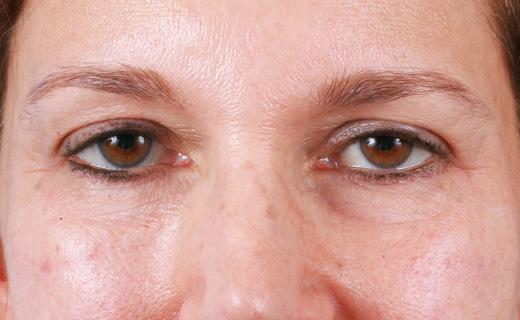 Blepharoplasty after at Aesthetic Center at Woodholme in Baltimore, MD