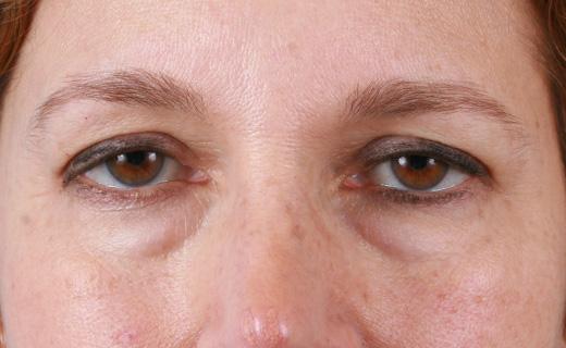 Blepharoplasty before at Aesthetic Center at Woodholme in Baltimore, MD
