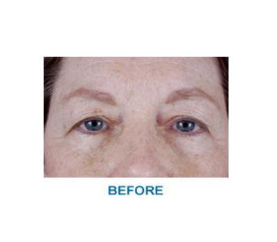 Brow Lift before at Aesthetic Center at Woodholme in Baltimore, MD
