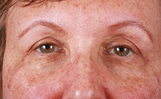 Blepharoplasty after at Aesthetic Center at Woodholme in Baltimore, MD