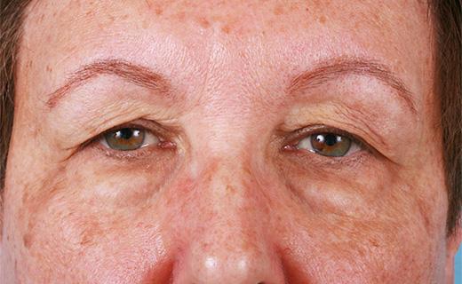 Blepharoplasty before at Aesthetic Center at Woodholme in Baltimore, MD