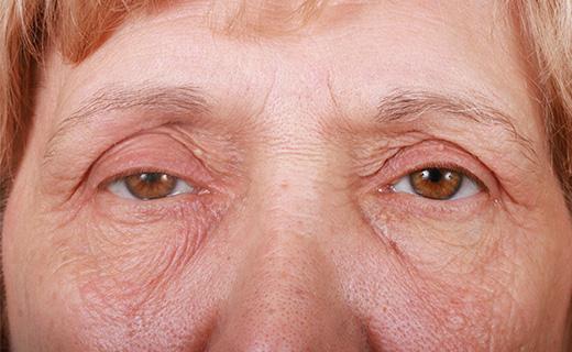 Blepharoplasty before at Aesthetic Center at Woodholme in Baltimore, MD
