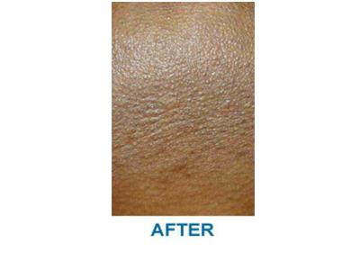 Morpheus8 after at Aesthetic Center at Woodholme in Baltimore, MD