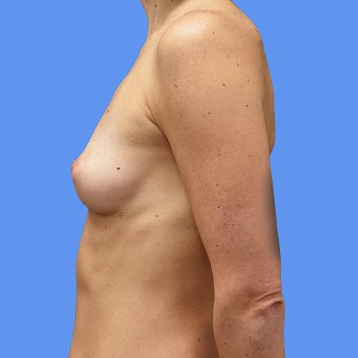 Fat Transfer Breast Augmentation before at Aesthetic Center at Woodholme in Baltimore, MD
