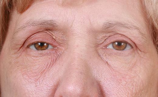 Brow Lift before at Aesthetic Center at Woodholme in Baltimore, MD