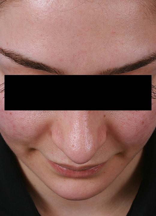 Aesthetic Center at Woodholme rhinoplasty after — Baltimore, MD